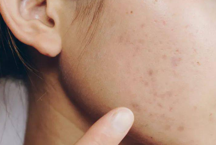 色素沈着 Ai Beauty Clinic